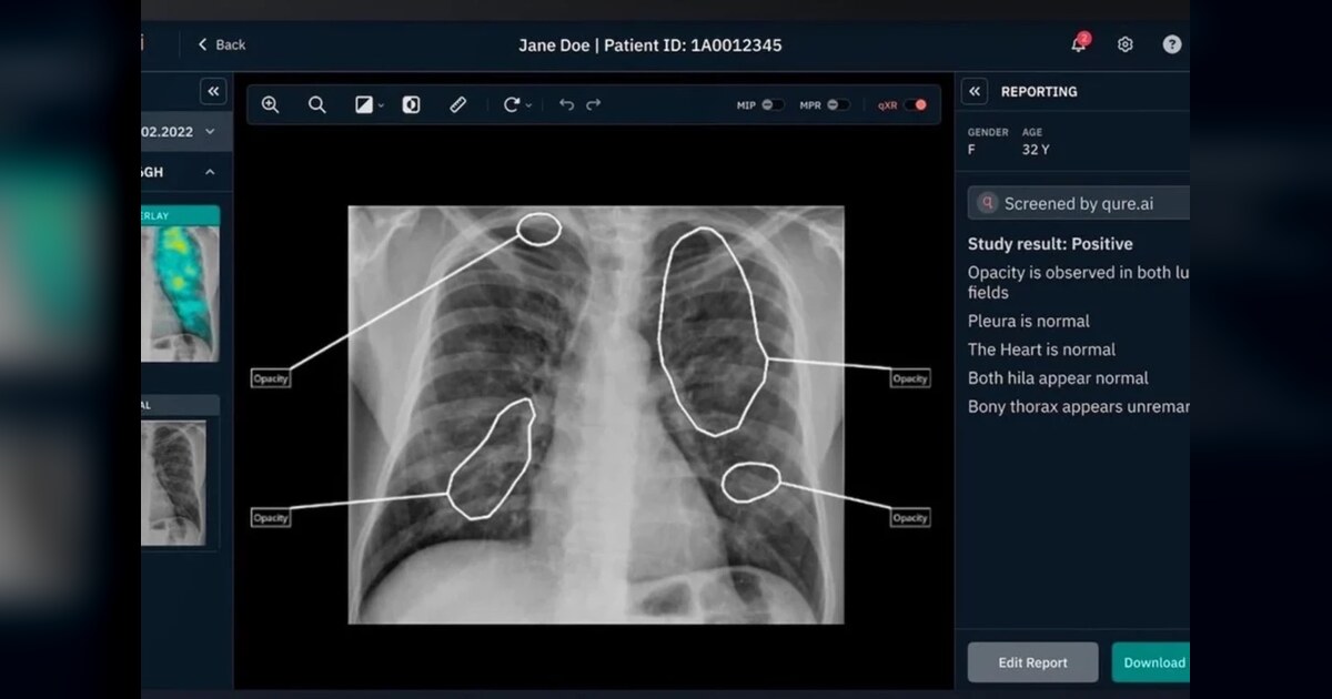 AI Chest X-Ray Tool Could Cut PH TB Screening Costs